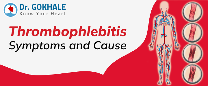 Thrombophlebitis Symptoms and Causes